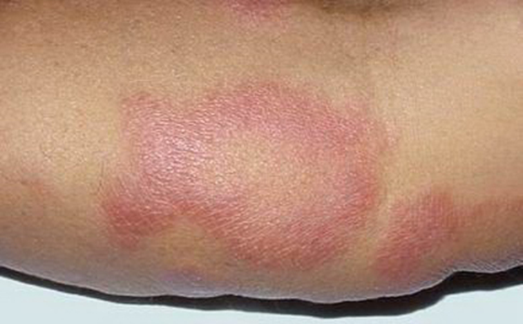 得了麻风病有哪些表现